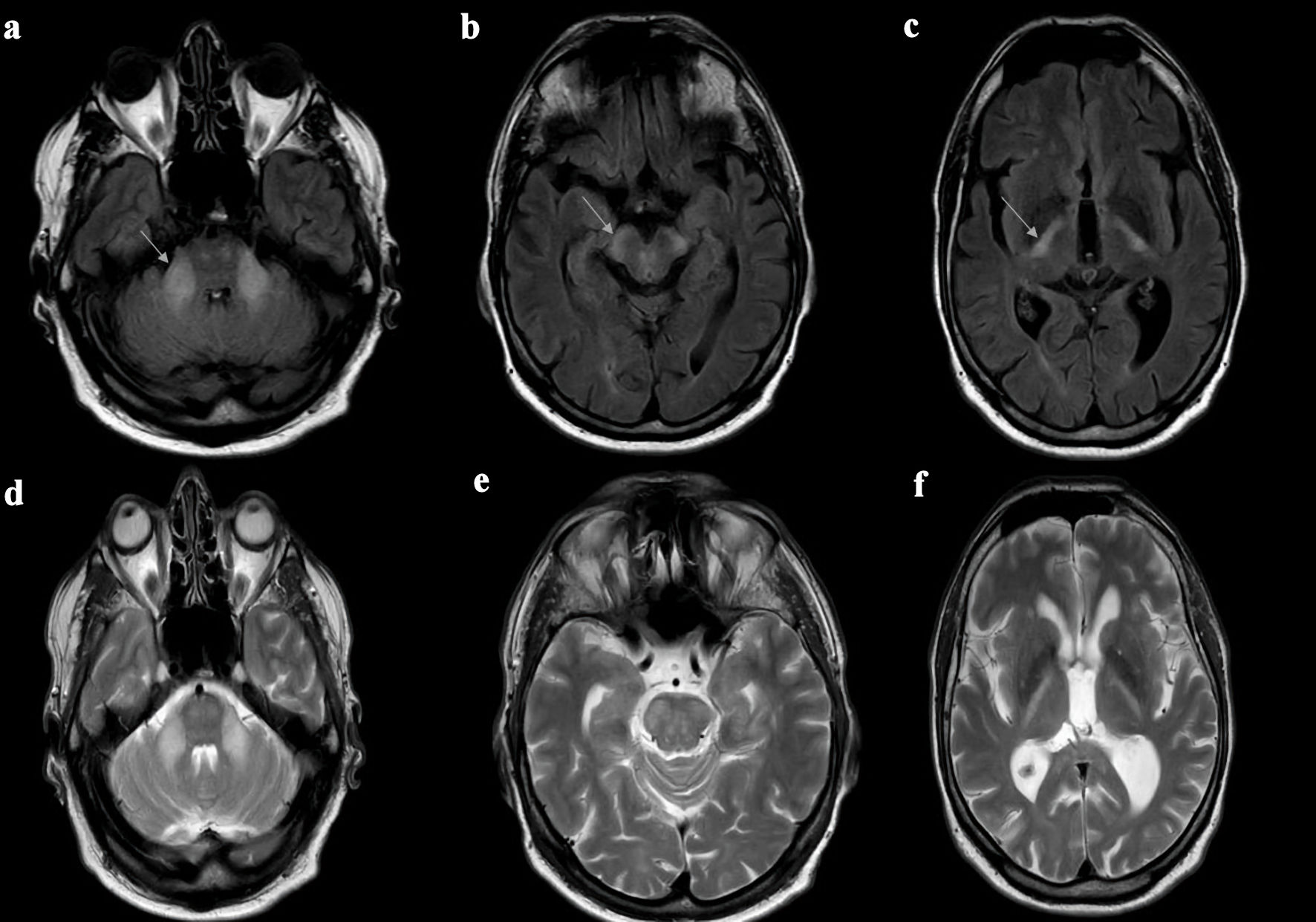 Late-Onset CLCN2-Related Leukodystrophy Associated With A Novel Mutation